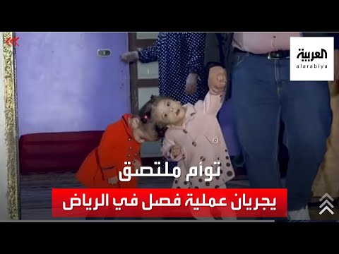 التوأم الملتصق سارة وسلمى إلى الرياض لإجراء جراحة الفصل