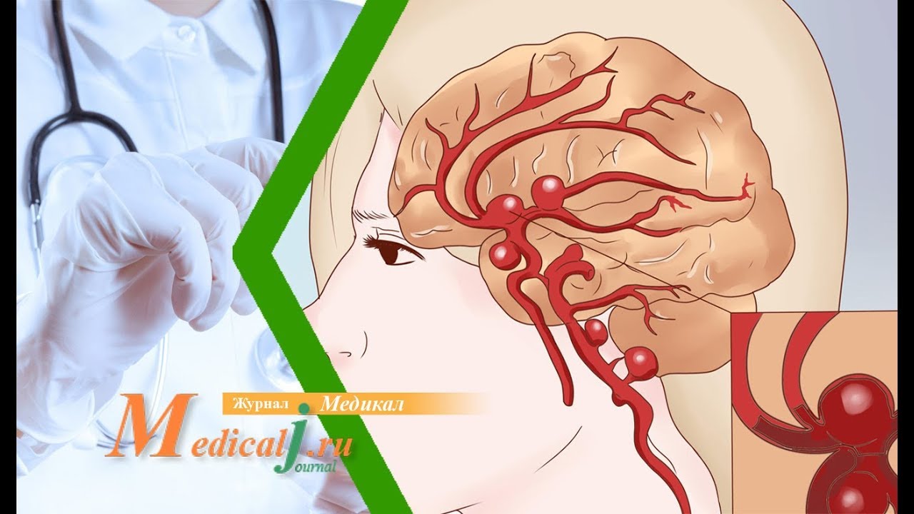 Аневризма артерий головного мозга. Причины. Симптомы. Лечение. - YouTube