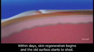 Skin Perfect Medical - Portrait Plasma