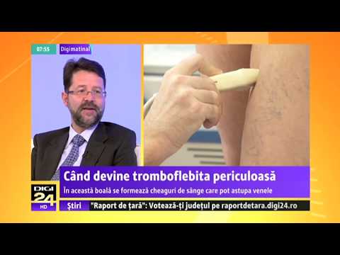 Operație varice cu laser | Cauze și tratament vene varicoase | Dr. Ștefan Jianu | Institutul Venelor