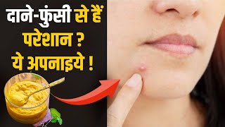चेहरे पर दाने-फुंसी से परेशान हैं तो ये रामबाण इलाज जरुर अपना लीजिए !