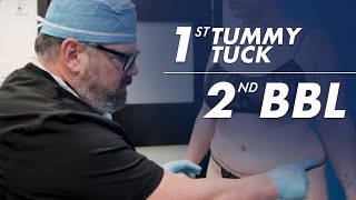 BBL After a Tummy Tuck Results