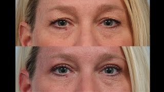 Female Upper Eyelid Sliver Blepharoplasty by Dr. Edwin Williams in his Latham clinic near Albany NY