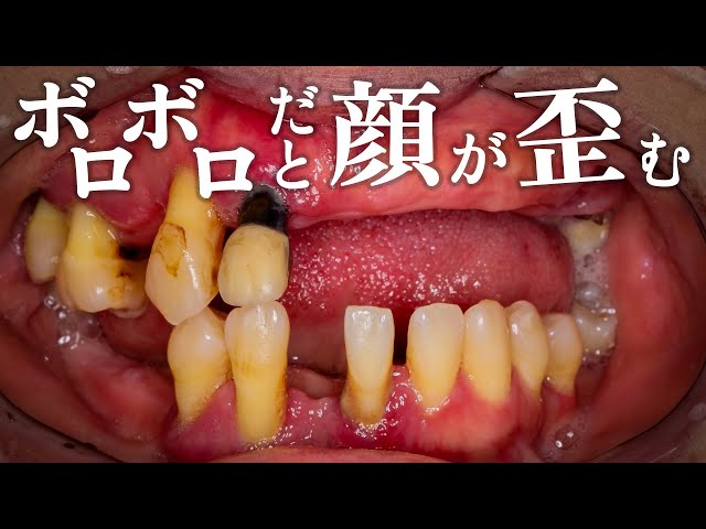 えっ】ボロボロの歯のままおクチが曲がる？ - YouTube