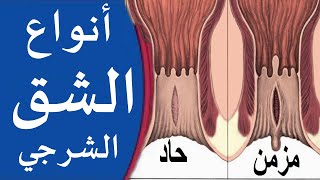 انواع الشق الشرجي | علاج اعراض واسباب جرح في فتحة الشرج والفرق بين الشرخ الحاد والمزمن