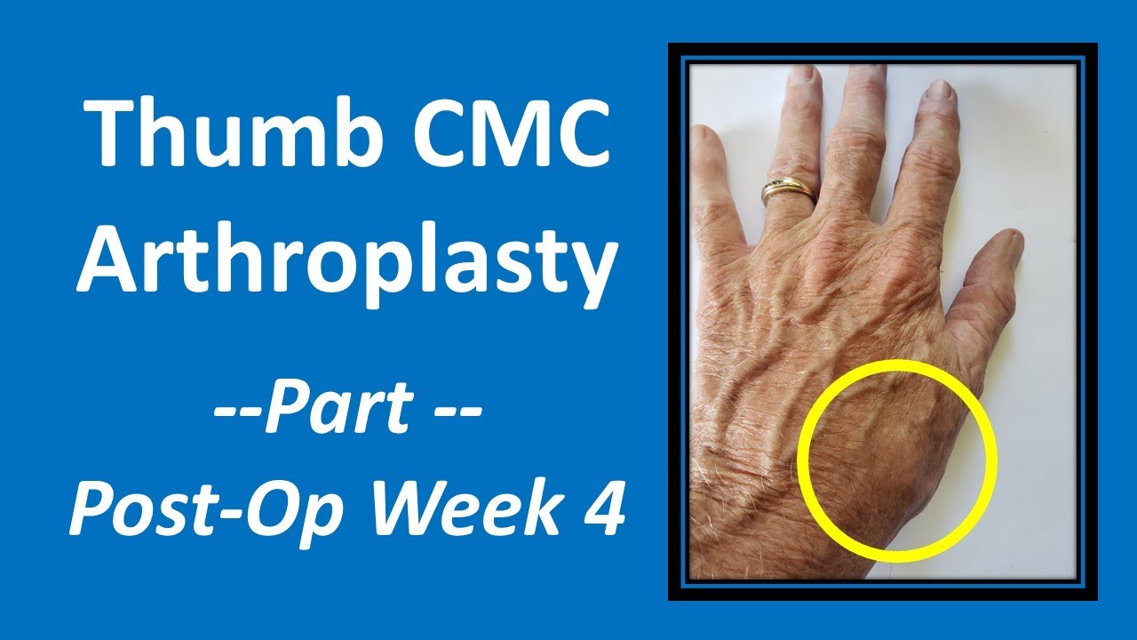 Thumb CMC Arthroplasty Part 4 Post Op Week 4 cmc YouTube Thumb CMC Arthroplasty Part 4 Post Op Week 4 cmc YouTube