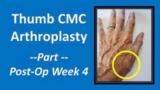 Thumb CMC Arthroplasty:  Part 4 Post-Op Week 4 #cmc