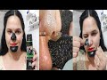 नाक और ठोड़ी के Blackheads एक बार हटने के बाद वापस कभी नहीं आएंगे | Remove Blackheads Permanently