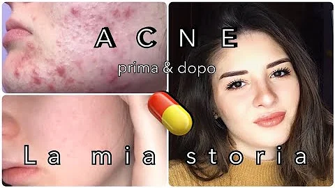 Qual è la pillola migliore per l'acne?