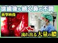 【大量の膿】抜歯しても治らない鼻の不調…「歯性上顎洞炎」の手術を耳鼻科医が徹底解説