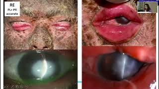 AIOCMTC4 2025 GP45 T Dr Mariya Doctor Microbial Keratitis in Ichthyosis Diagnostic Challenges