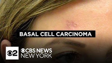 Dermatologist explains the dangers of basal cell carcinoma, what to look out for
