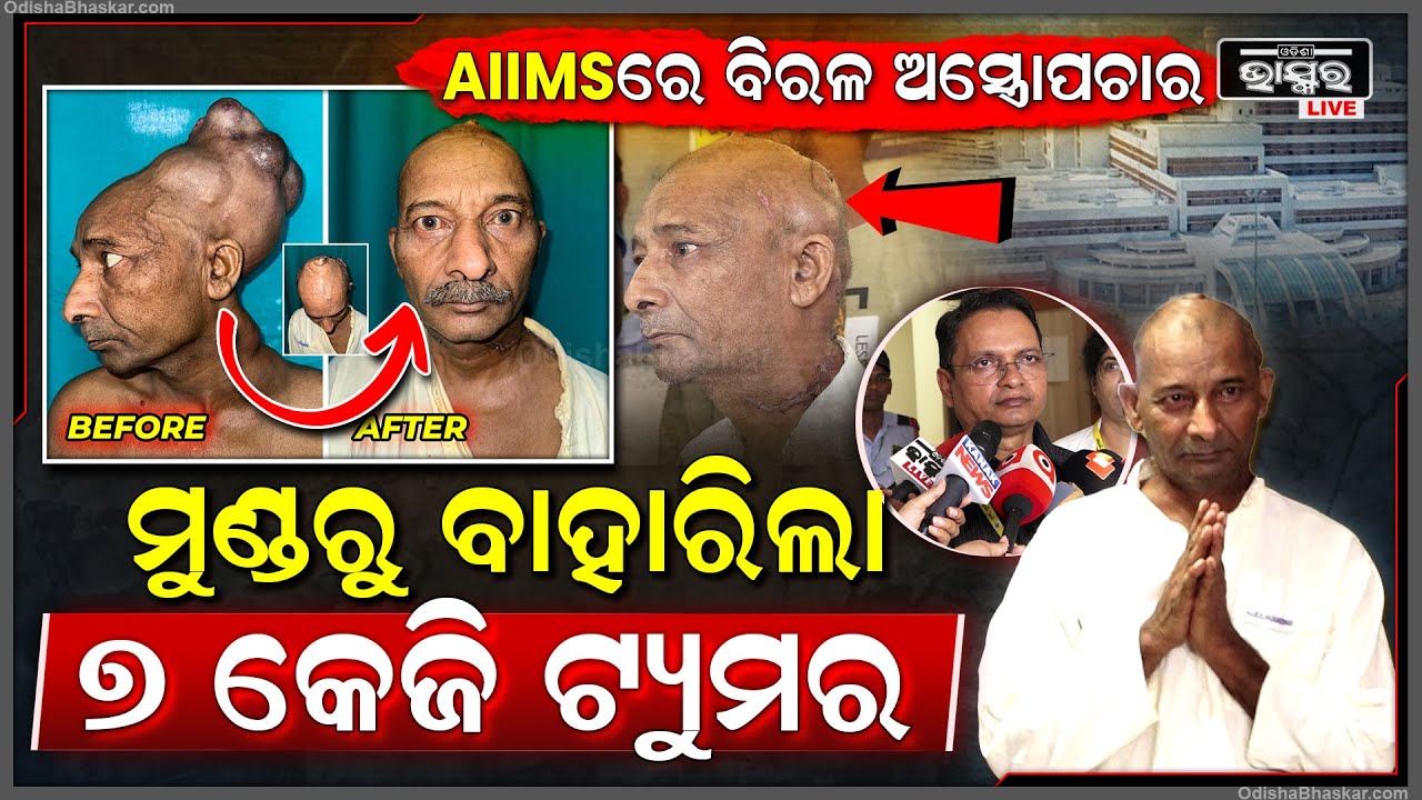 AIIMS ରେ ହେଲା ବିରଳ ଅସ୍ତ୍ରୋପଚାର I ମୁଣ୍ଡରୁ ବାହାରିଲା ୭ କେଜିର ଟ୍ୟୁମର...୨୪ ବର୍ଷ ଧରି ହୋଇପାରୁନଥିଲା ସର୍ଜରୀ
