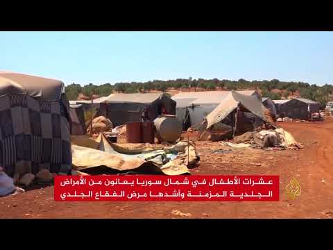 "الفقاع الجلدي".. مرض يفاقم معاناة الأطفال بشمال سوريا