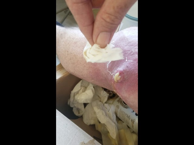 Knee Infection