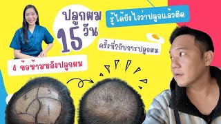 15 วัน หลังปลูกผม รู้ได้ยังไงว่ากราฟไม่หลุด ที่ GROW & GLOW Clinic #T3B #ปลูกผมถาวร