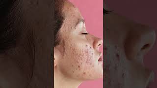 Do Egg's cause acne ?#acne #acnetreatment #skincareproduct Net Worth