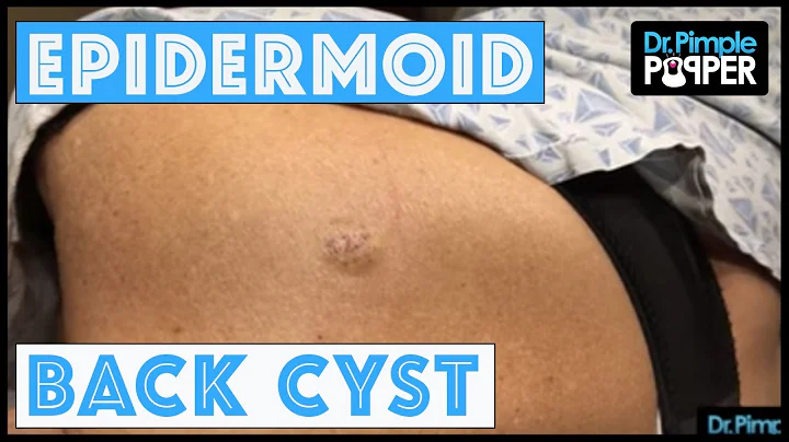 An Epidermoid Cyst: Let's cure it with a curette!