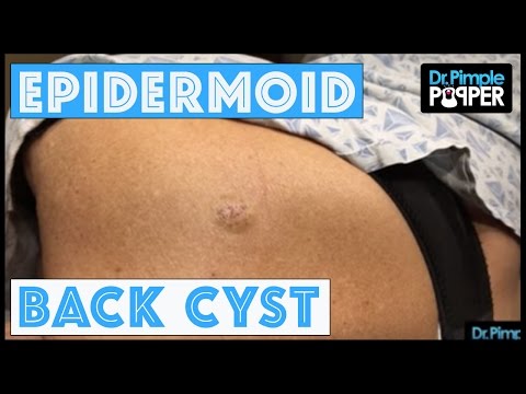 An Epidermoid Cyst: Let's Cure It With A Curette!