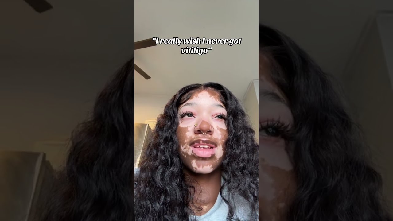 Some Things Can Remain INSIDE THOUGHTS Vitiligo