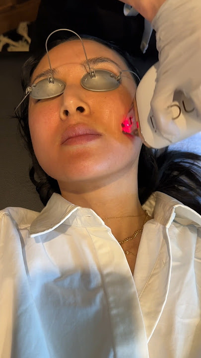 Zaps melasma away?! My MOXI Laser experience #lasertreatment #