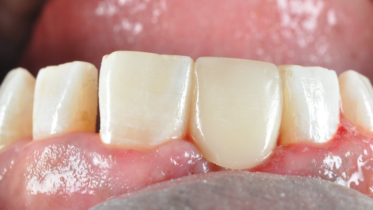 Fiber reinforced composite Bridge