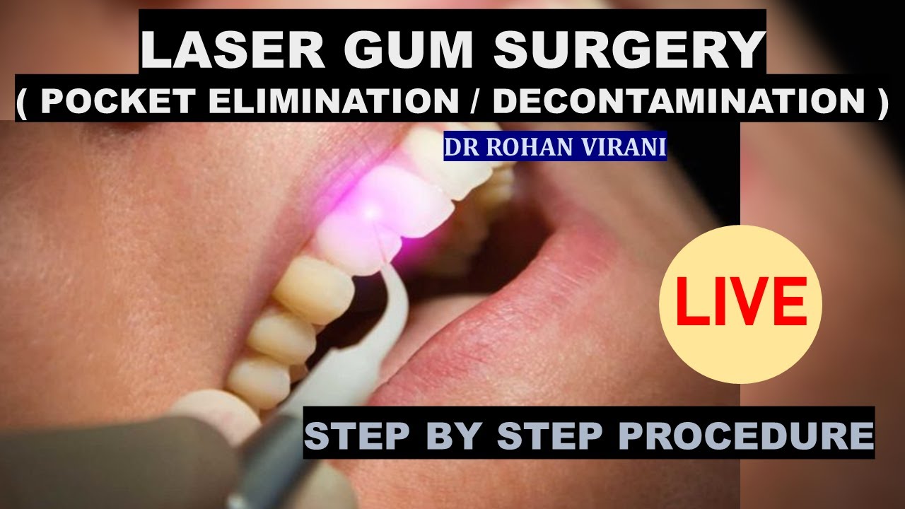 Laser Gum Surgery ( Pocket Elimination / Decontamination ) Dr Rohan