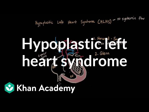 Hypoplastic left heart syndrome and norwood glenn fontan | NCLEX-RN | Khan Academy