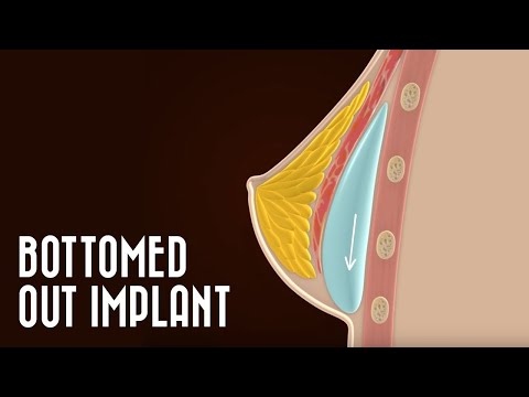 Bottoming Out - a customised video animation demonstrating what happen
