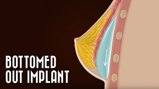 BOTTOMING OUT - Dr Eddy Dona explains this potential complication of breast implants
