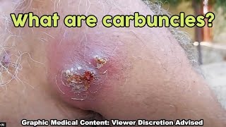 A boil is a painful, pus-filled bump that forms under your skin when bacteria infect and inflame