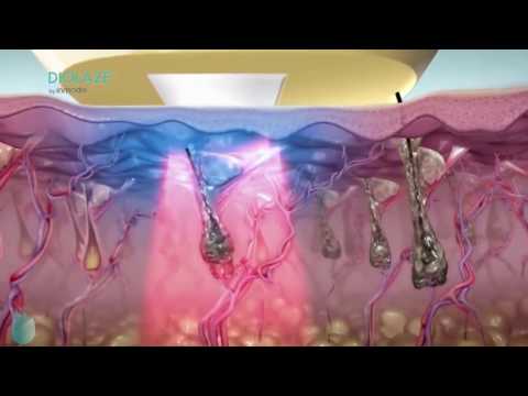 HairFix: Laser Hair Removal Small