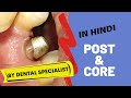 Post and core in Hindi | Patient education video