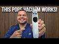 Stubborn Blackheads Gone in Seconds with This Device