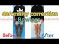 Different Surgical Methods For Bowlegs Correction