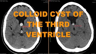 Clinical Case - Enlarging Colloid Cyst Of The Third Ventricle - Important Finding Not To Miss On Ct