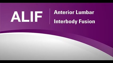 Nuvasive: ALIF Animation