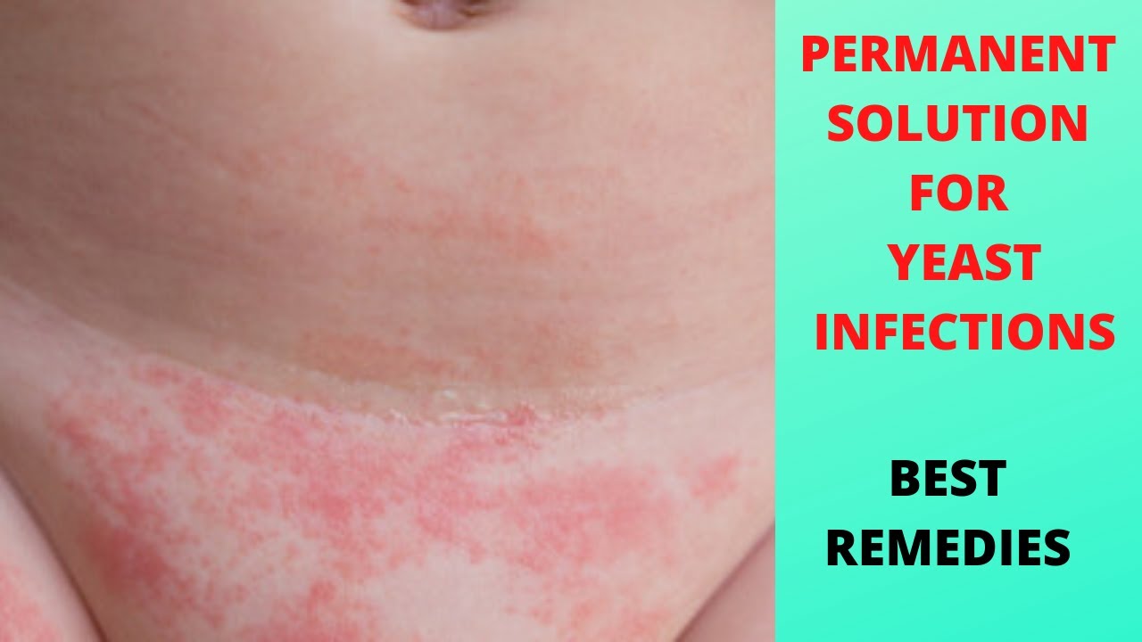 YEAST INFECTIONHome remedies for yeast infectionYeast infection