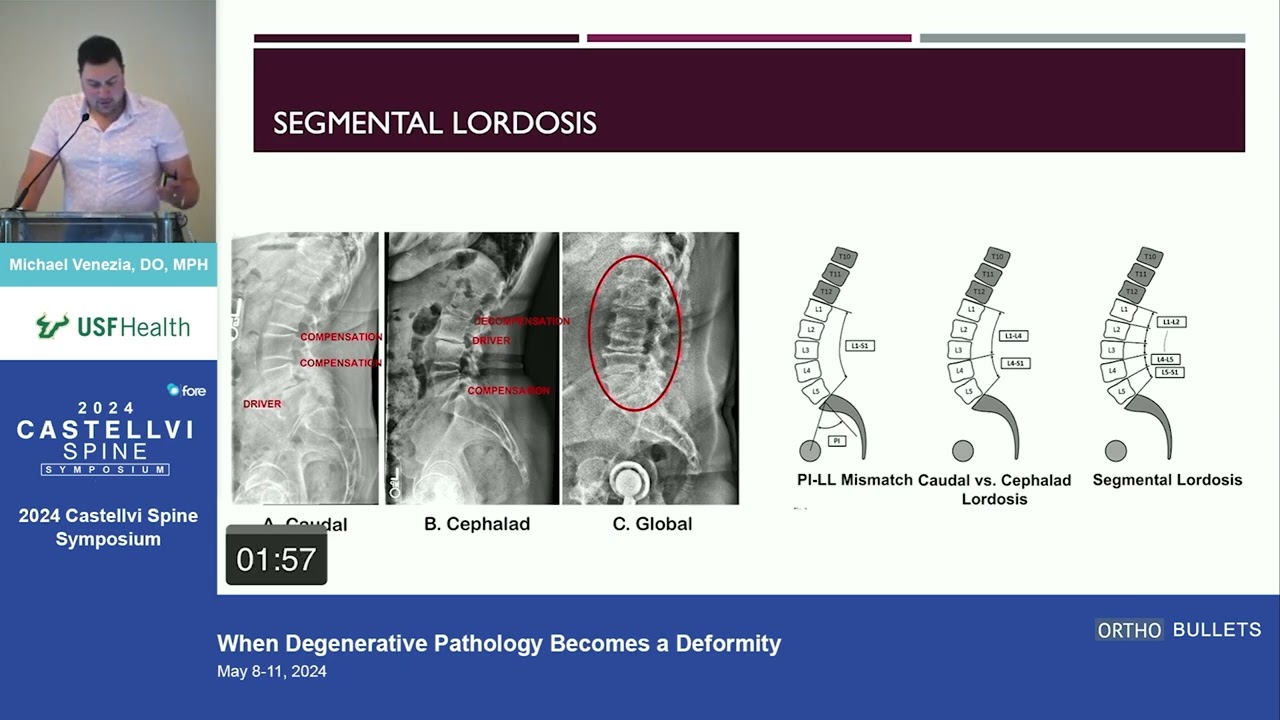 When Degenerative Pathology Becomes a Deformity - Michael Venezia, DO, MPH