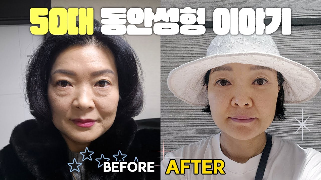 50대 여성의 안티에이징! 이마거상, 하안검 수술 2개월차 경과🌷✨