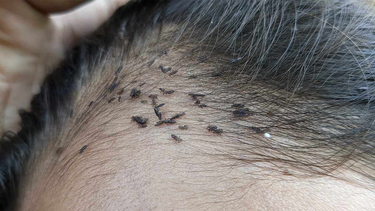 How to pick out thousand head lice from head Comb thousand head lice