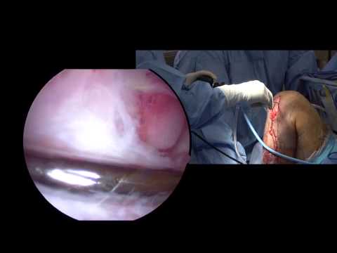 Anatomic ACL Reconstruction using ENDOBUTTON* CL BTB