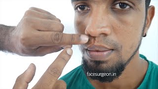 Mustache Transplant Before and After - Moustache Hair loss patch - Moustache Hair transplantation