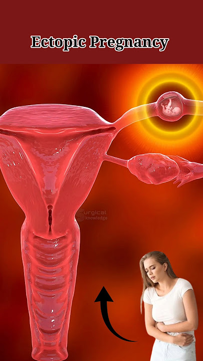 Ectopic Pregnancy #ectopicpregnancy #pregnancy #miscarriages #pregnant #pregnancyjourney