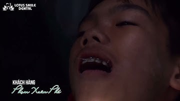 HÀNH TRÌNH NIỀNG RĂNG BỀN BỈ - AN TOÀN CÙNG LOTUS SMILE