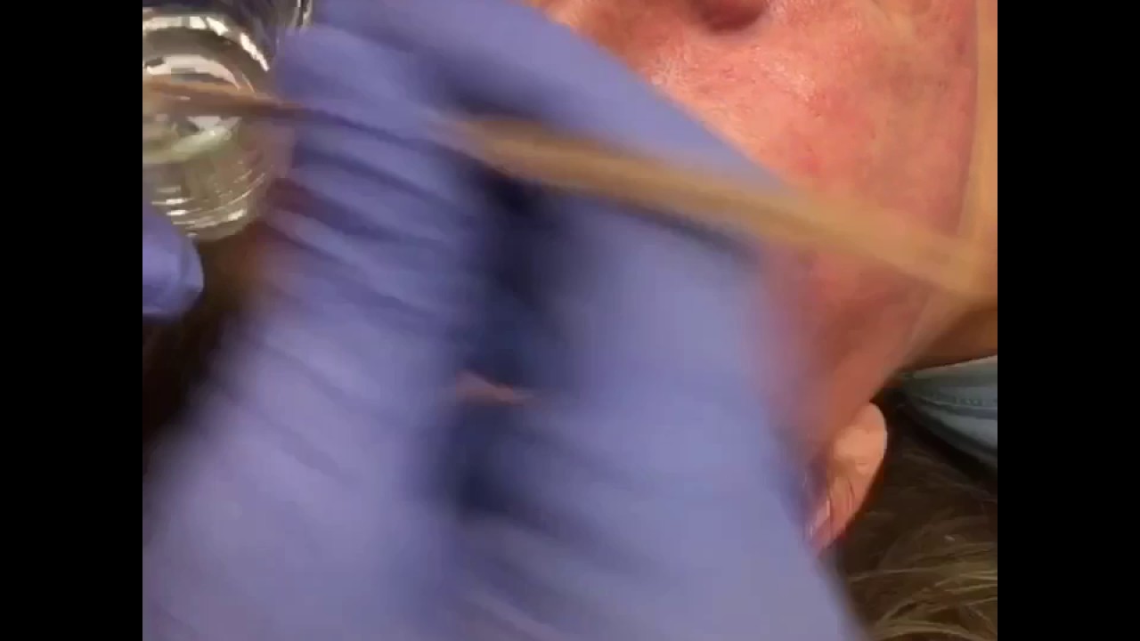 Chemical peel for skin rejuvenation!