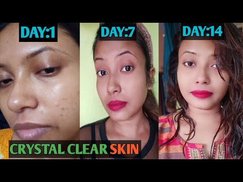 How to get crystal clear skin just in 14 days || my real acne story and ...