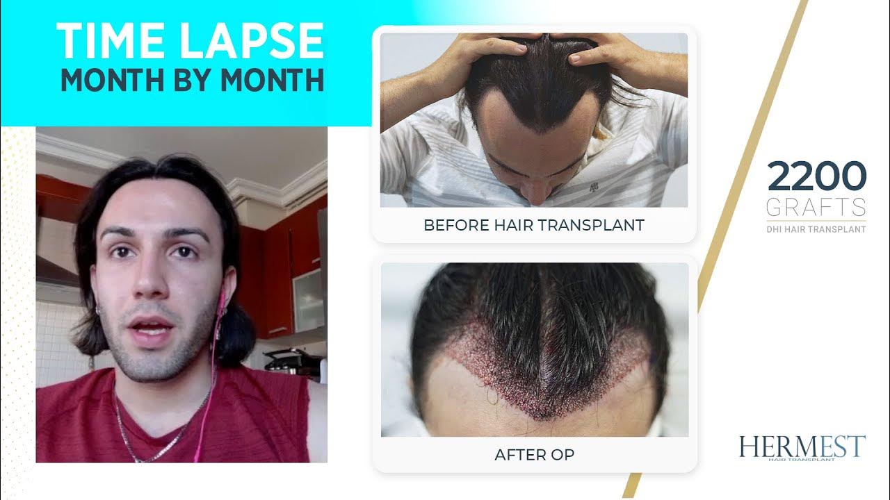 DHI Hair Transplant Time lapse in Turkey (Before & After) Hermest Hair Clinic Reviews & Results