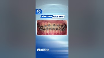 Tạm biệt khớp cắn ngược sau niềng răng  #nambuivinalign #dentist #niềngrăng