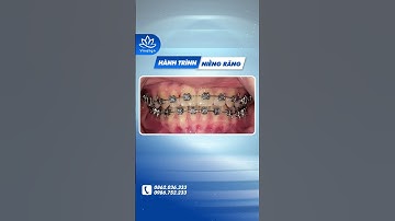 Tạm biệt khớp cắn ngược sau niềng răng  #nambuivinalign #dentist #niềngrăng